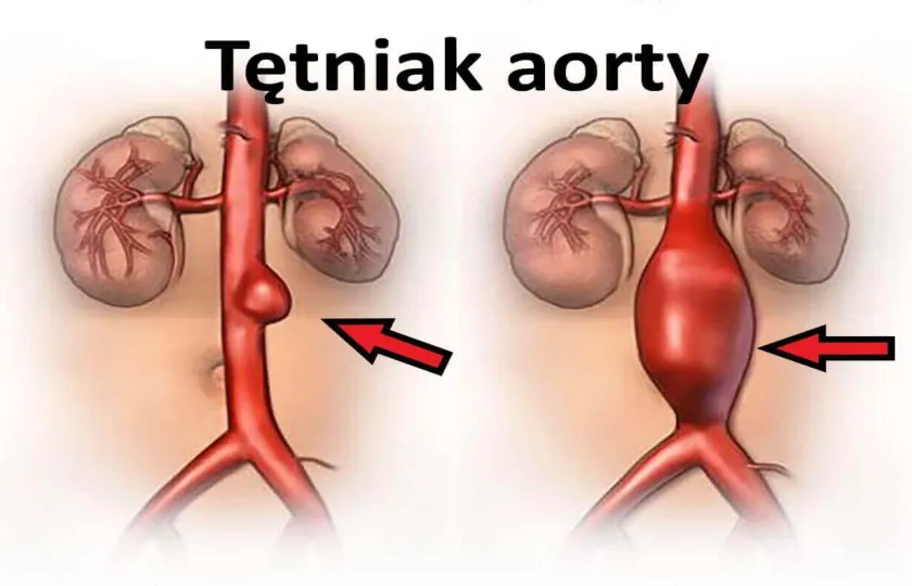 Tętniak aorty 