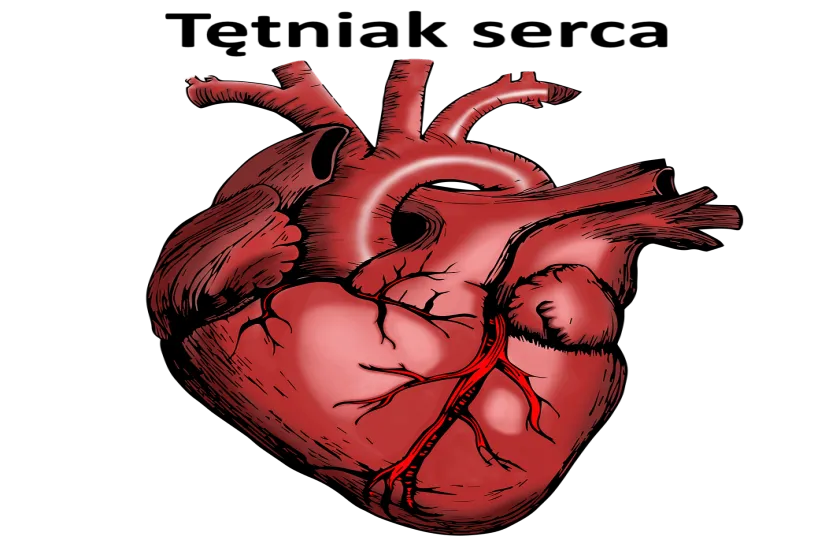Tętniak serca 