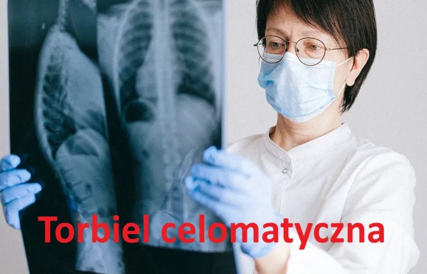 Torbiel celomatyczna