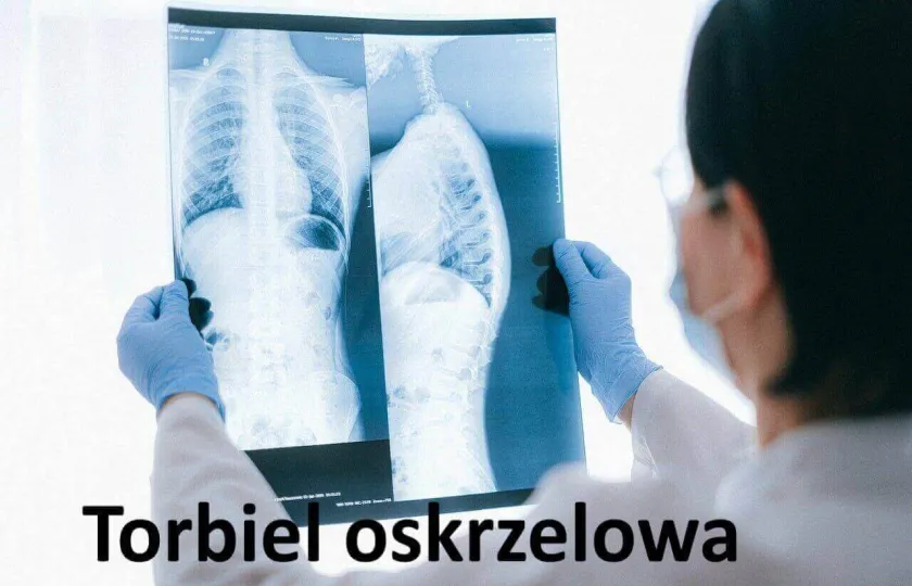 Torbiel oskrzelowa