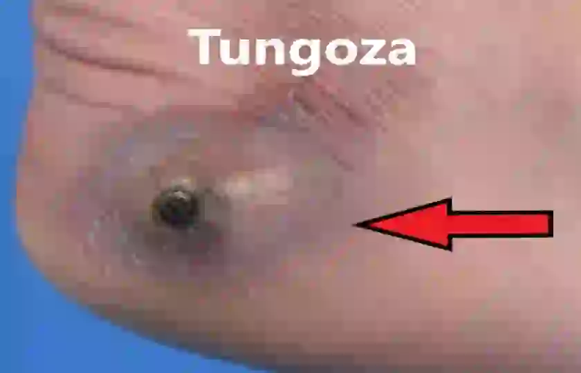 Tungoza, tungiaza, sarkopsyloza 