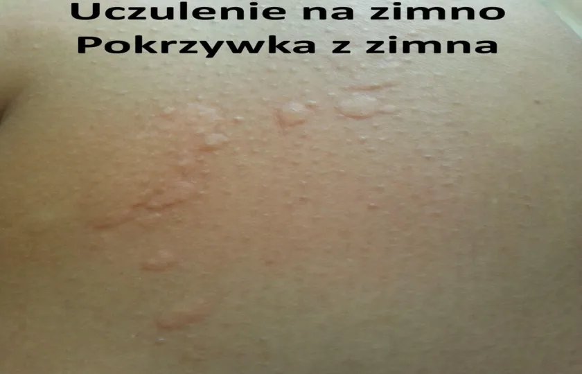 Uczulenie na zimno, pokrzywka z zimna