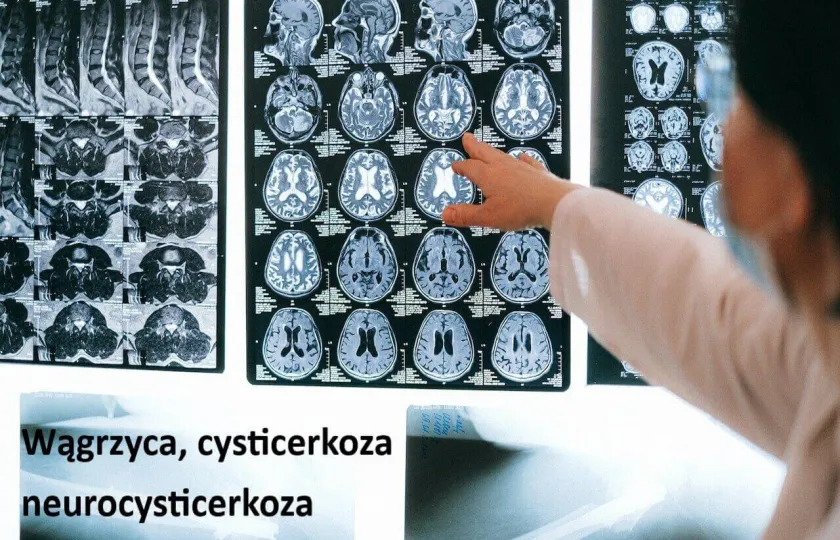 CYSTICERKOZA, NEUROCYSTICERKOZA, wągrzyca ośrodkowego układu nerwowego objawy leczenie