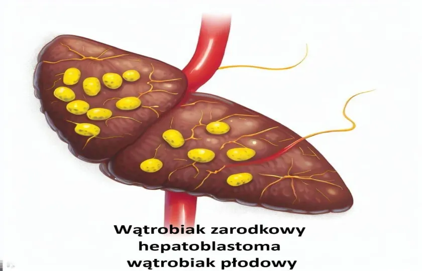 Wątrobiak zarodkowy, hepatoblastoma, wątrobiak płodowy