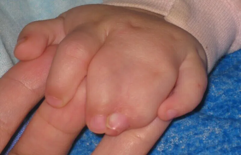 Wady wrodzone kończyn górnych, Poznaj najczęstsze wady wrodzone kończyn górnych