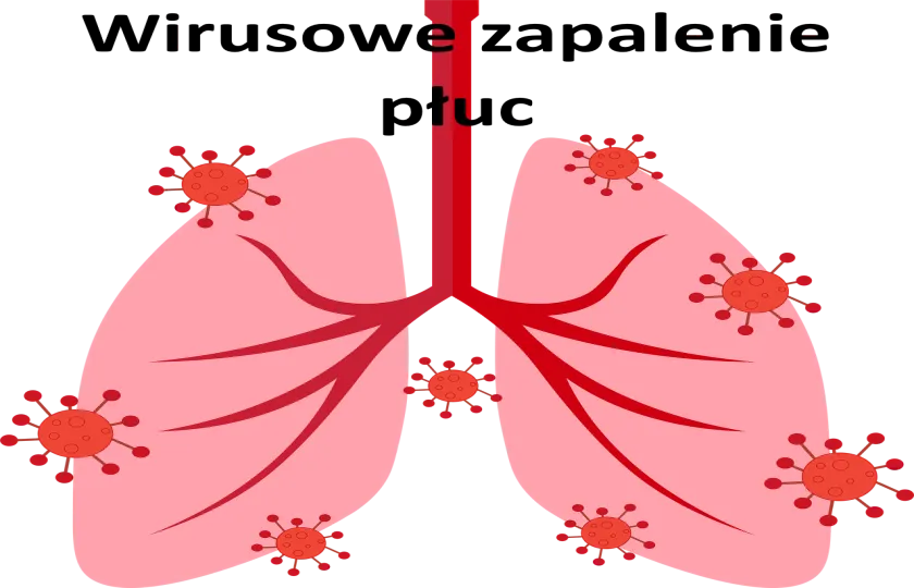 WIRUSOWE ZAPALENIE PŁUC, wirusowe zapalenie płuc rsv objawy u dziecka dorosłego leczenie 