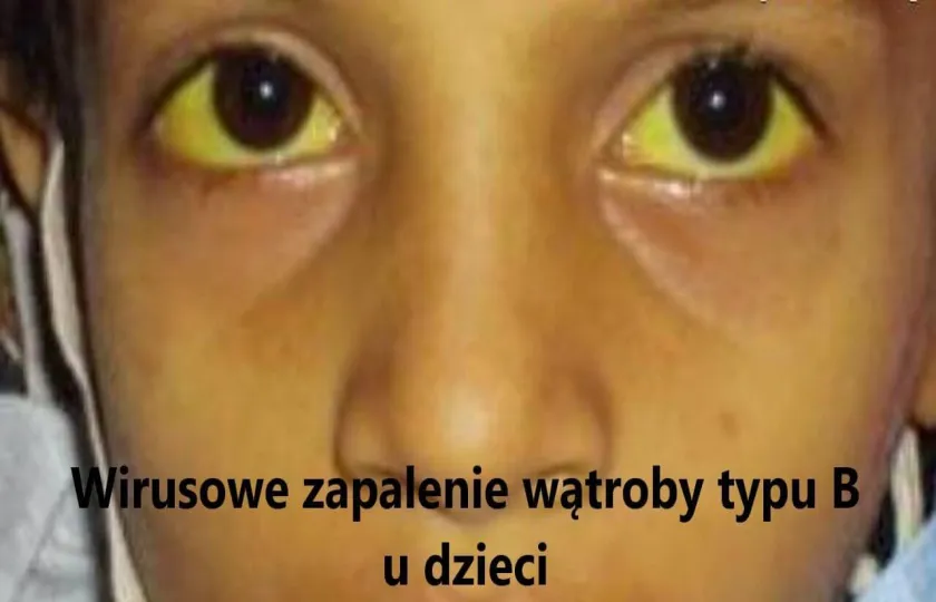 Wirusowe zapalenie wątroby typu B u dzieci