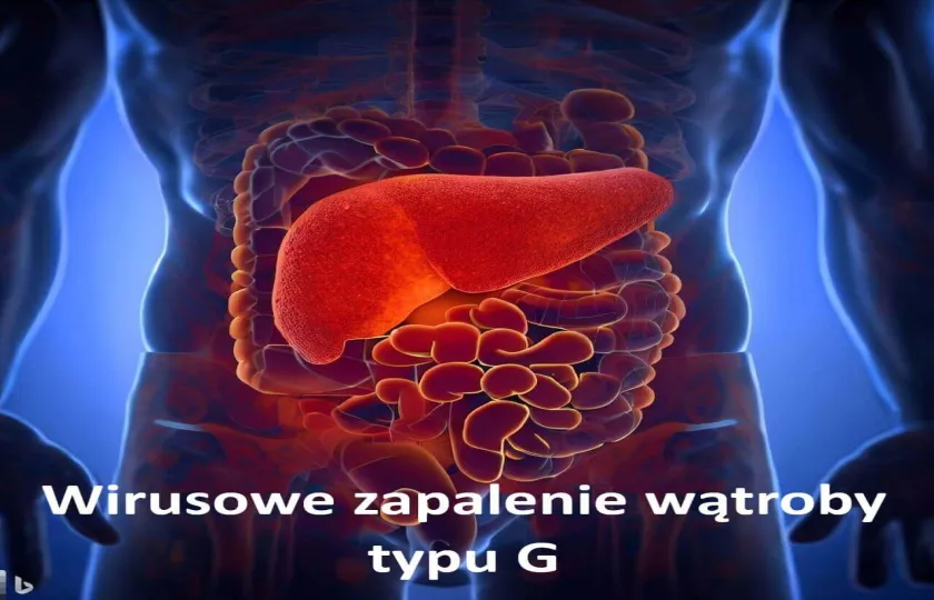 Wirusowe zapalenie wątroby typu G