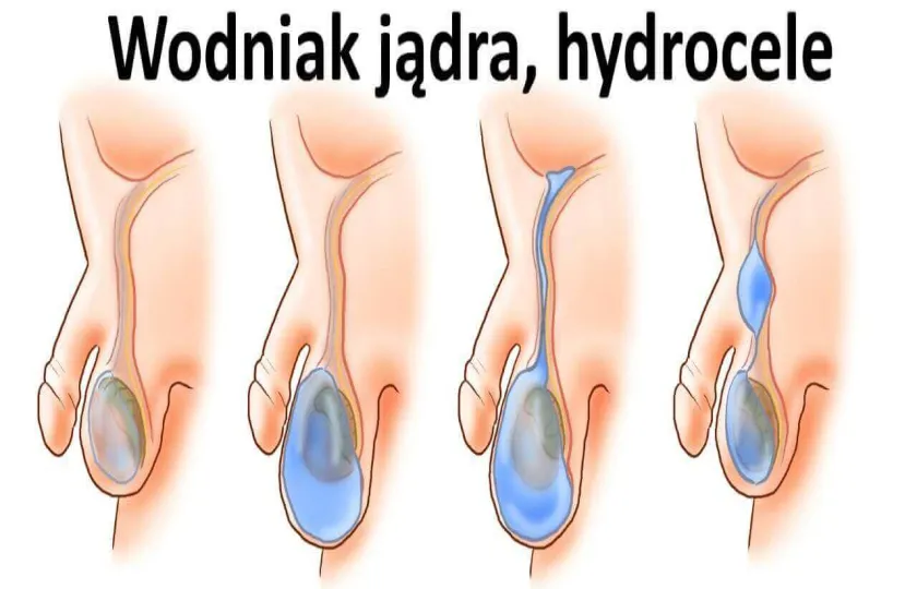 Wodniak jądra, hydrocele 