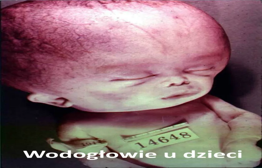 Wodogłowie u dzieci, wodogłowie dziecięce
