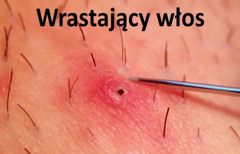 Wrastający włos, wrośnięty włos
