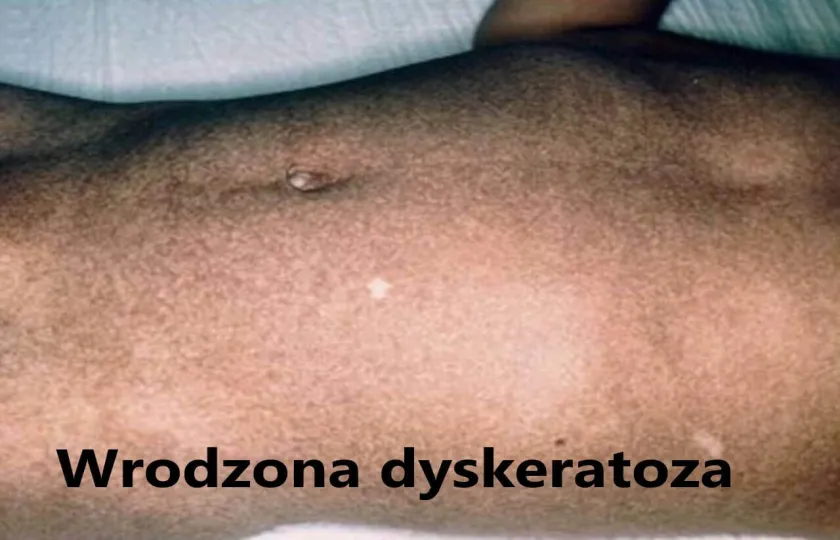 Wrodzona dyskeratoza 