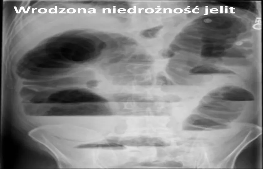 Wrodzona niedrożność jelit objawy u noworodka dzieci dorosłych