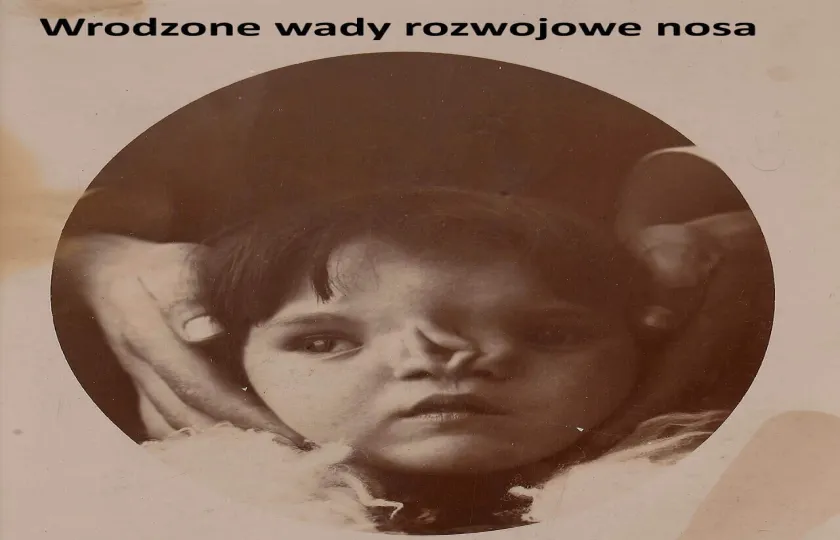 Wrodzone wady rozwojowe nosa