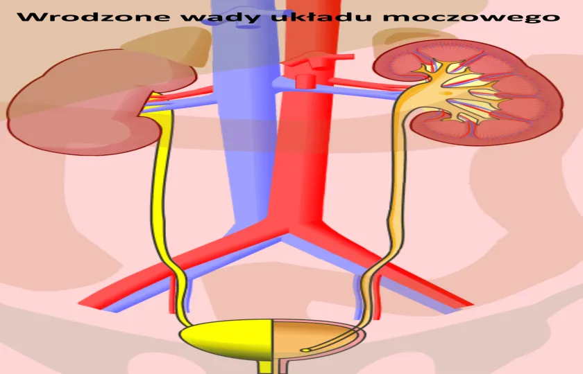 Wrodzone wady układu moczowego 