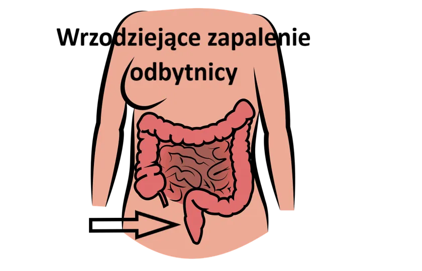 Wrzodziejące zapalenie odbytnicy