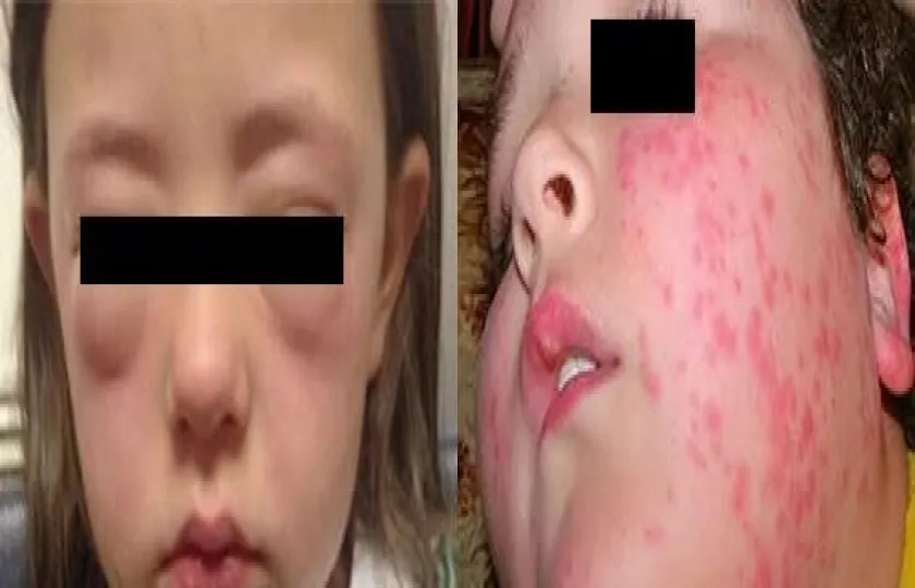 Wstrząs anafilaktyczny 