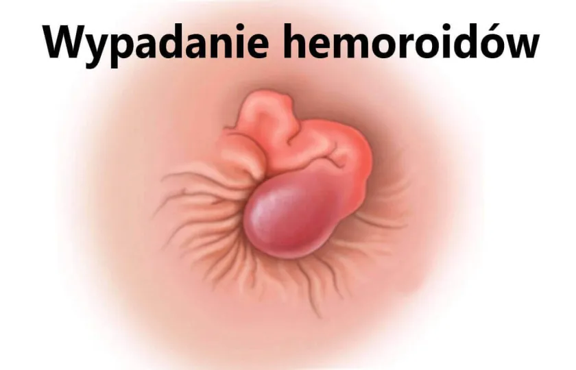 Wypadanie hemoroidów