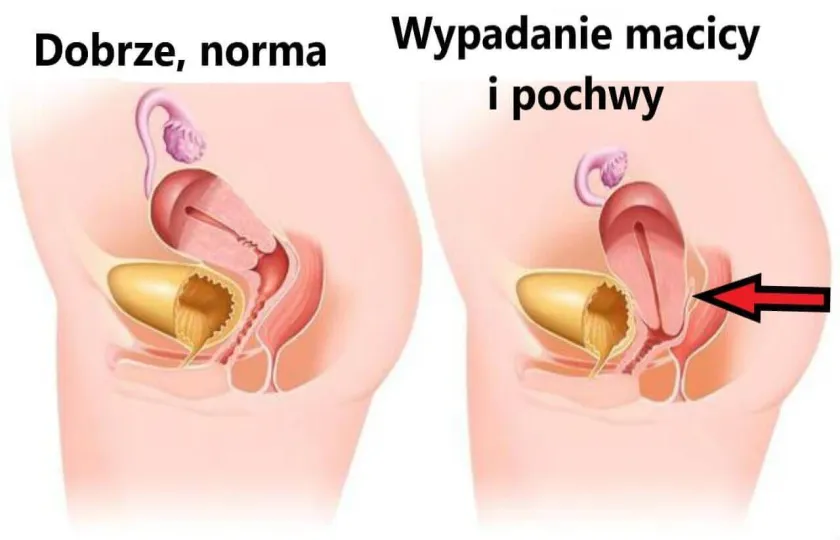Wypadanie macicy i pochwy