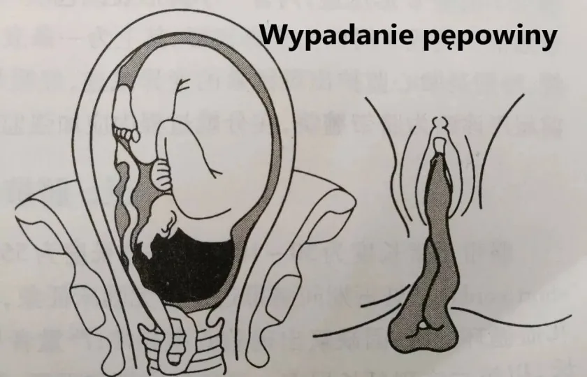 Wypadanie pępowiny