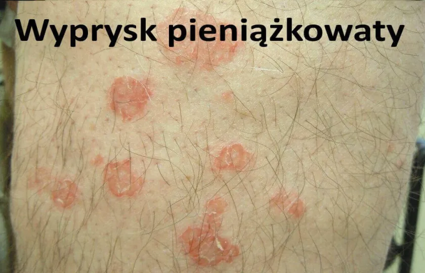 Wyprysk pieniążkowaty 