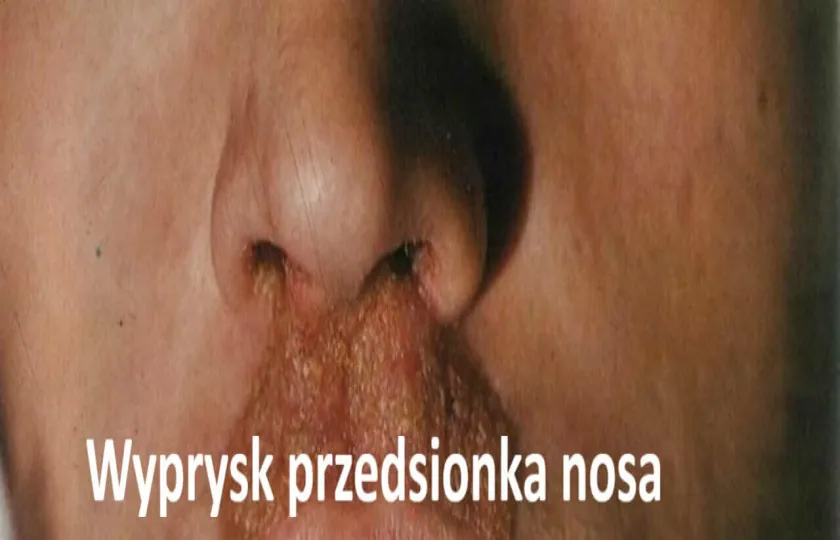 Wyprysk przedsionka nosa