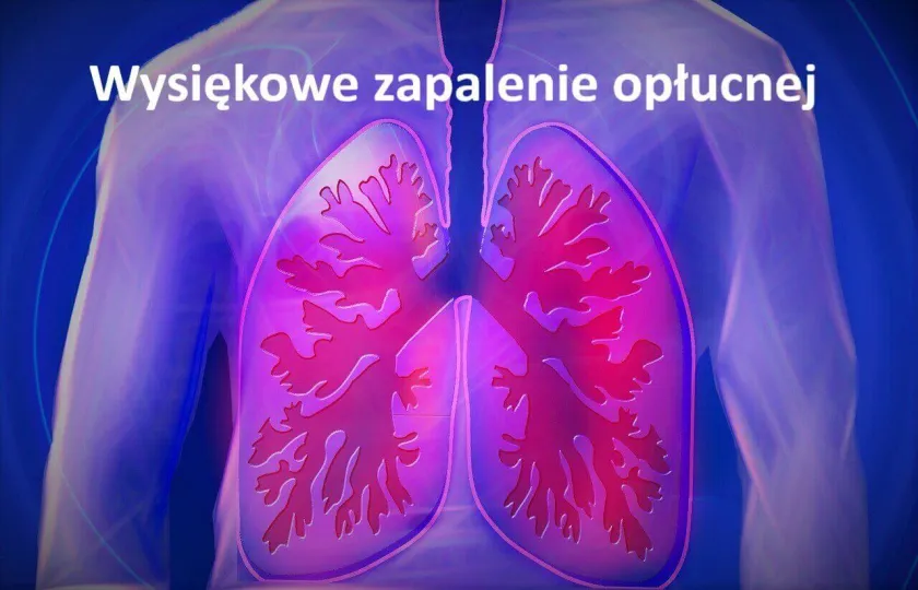 WYSIĘKOWE ZAPALENIE OPŁUCNEJ, WYSIĘK W JAMIE OPŁUCNEJ 