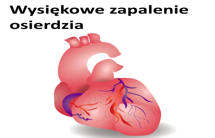 Wysiękowe zapalenie osierdzia