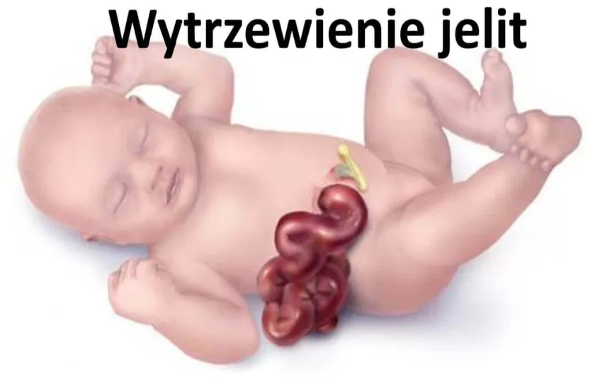 Wytrzewienie jelit 