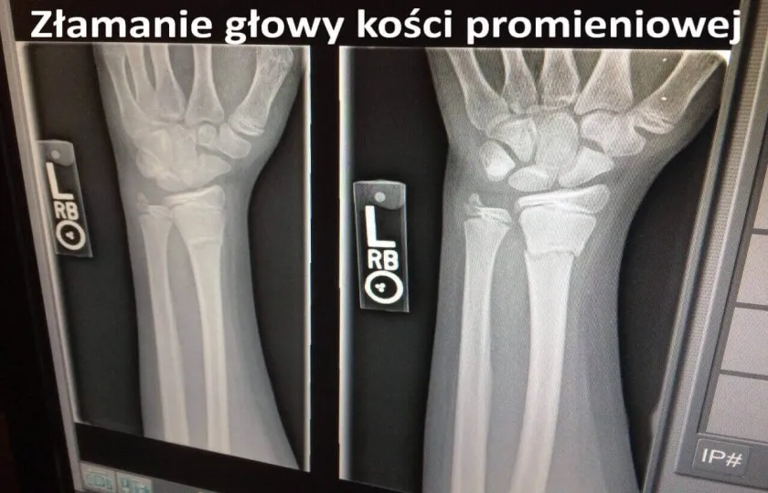 Złamanie głowy kości promieniowej