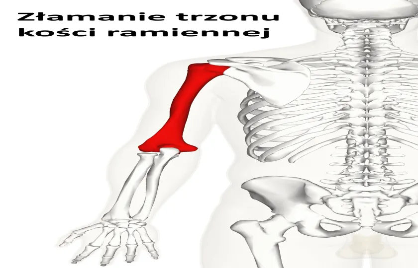 Złamanie trzonu kości ramiennej