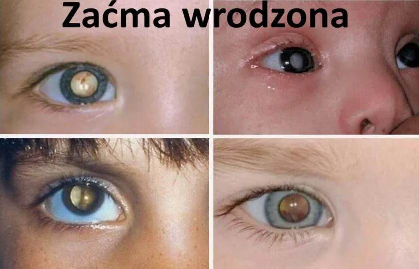 Zaćma wrodzona u noworodka dziecka dzieci 