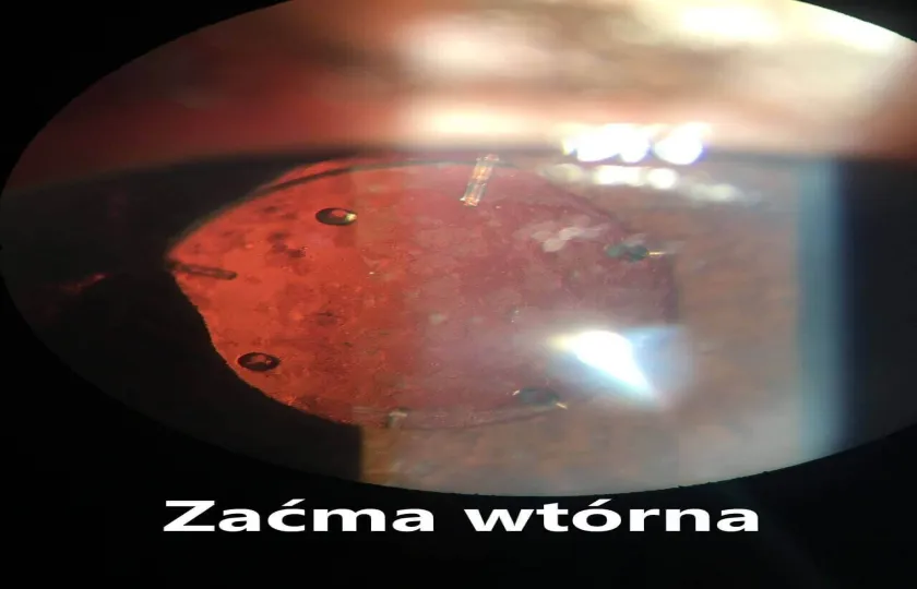 Zaćma wtórna objawy leczenie
