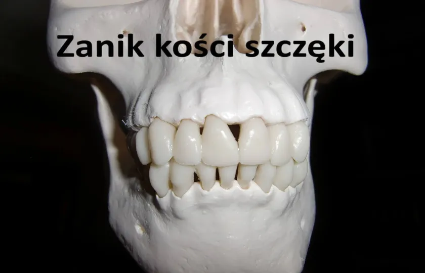 Zanik kości szczęki 