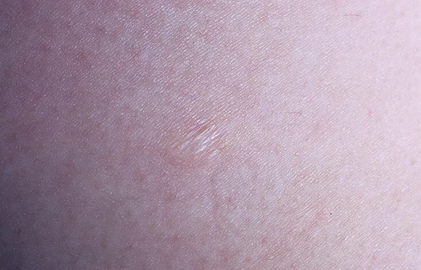 Zanik plamisty skóry