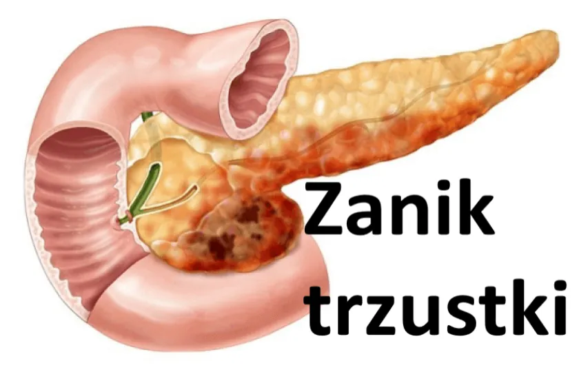 ZANIK TRZUSTKI, ATROFIA TRZUSTKI, TRZUSTKA ZANIKOWA 