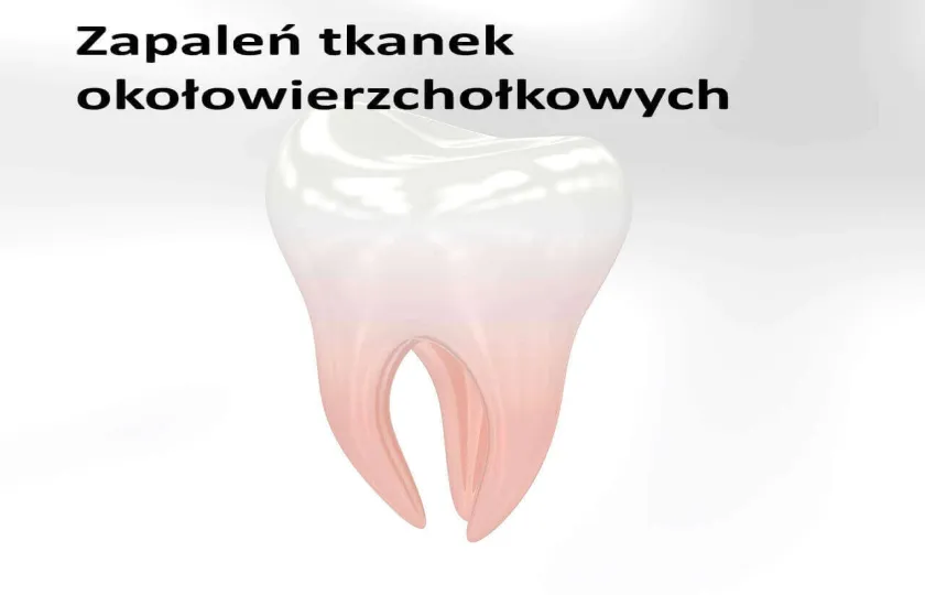 Zapaleń tkanek okołowierzchołkowych 
