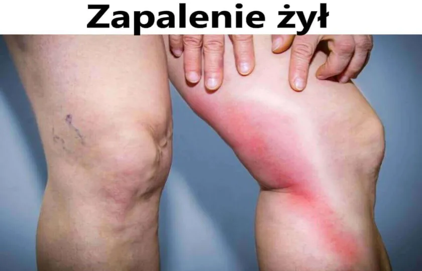 Zapalenie żył