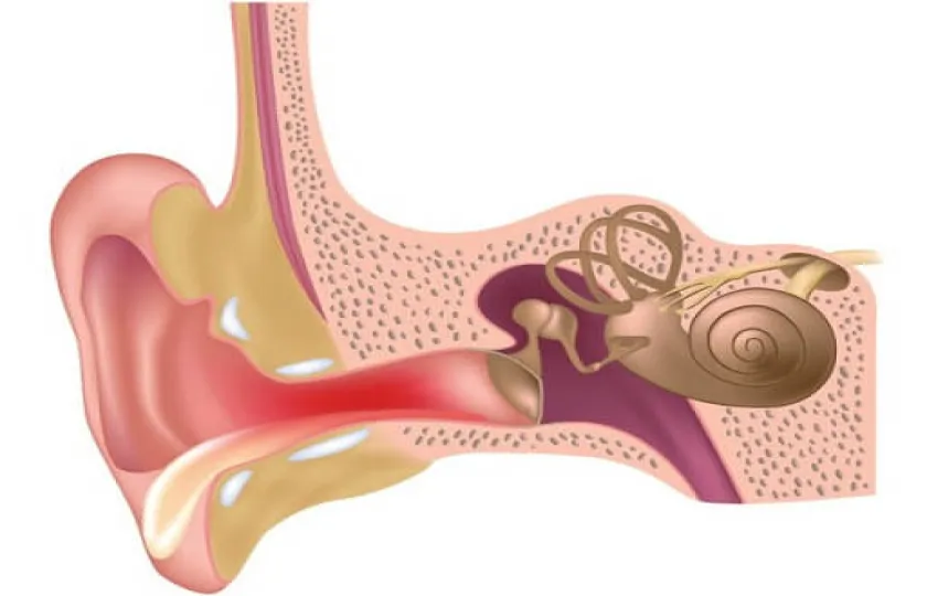 Zapalenie błędnika 