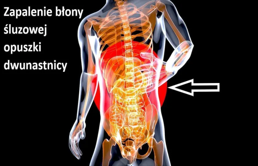 Zapalenie błony śluzowej opuszki dwunastnicy