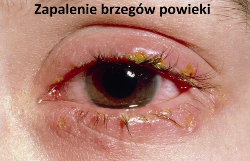 Zapalenie brzegów powieki 