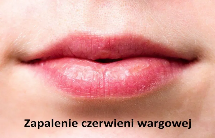 Zapalenie czerwieni wargowej