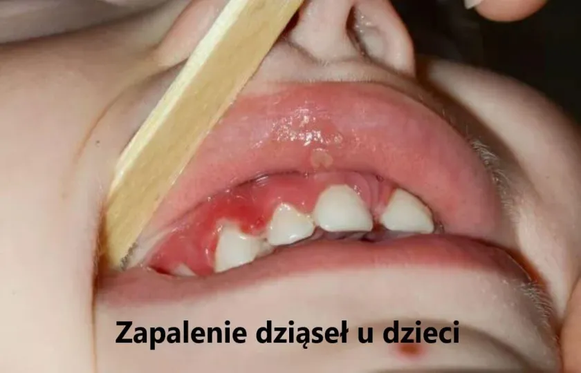 Zapalenie dziąseł u dzieci