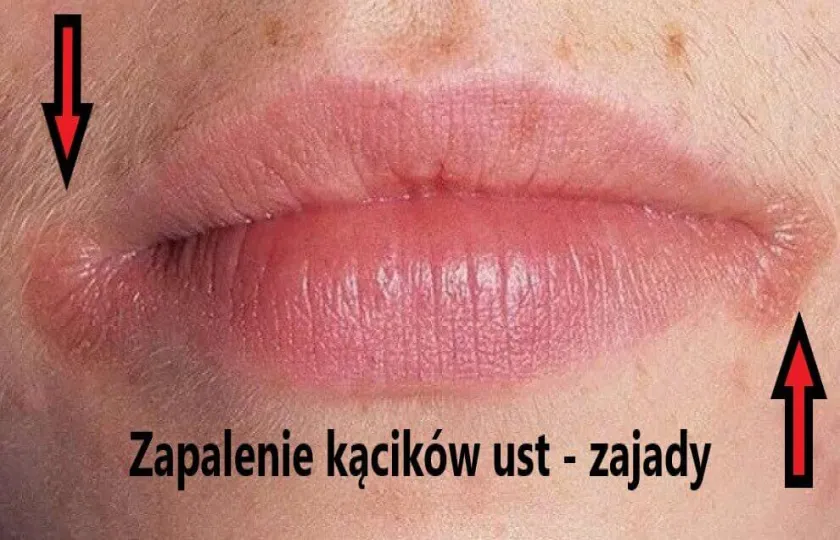 Zapalenie kącików ust, zajady