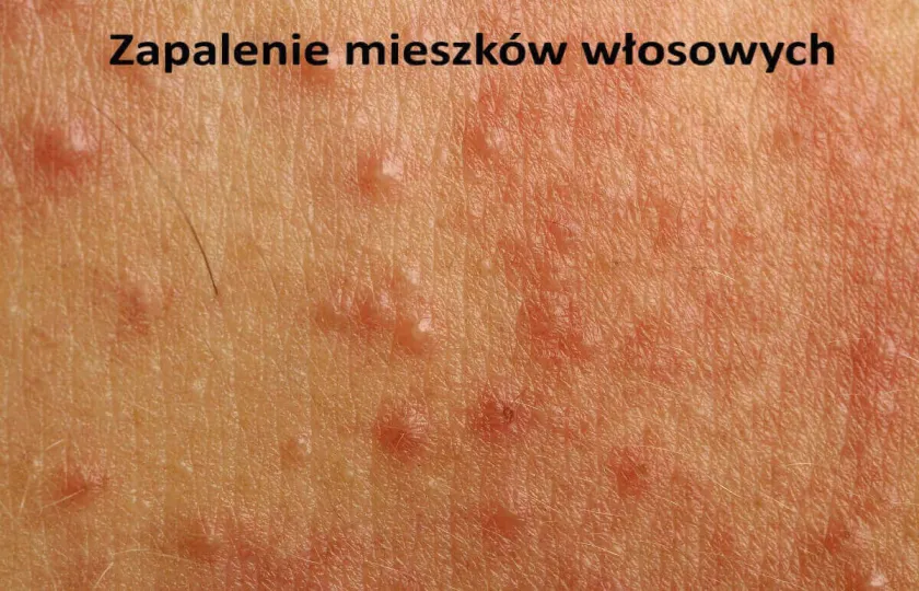 Zapalenie mieszków włosowych