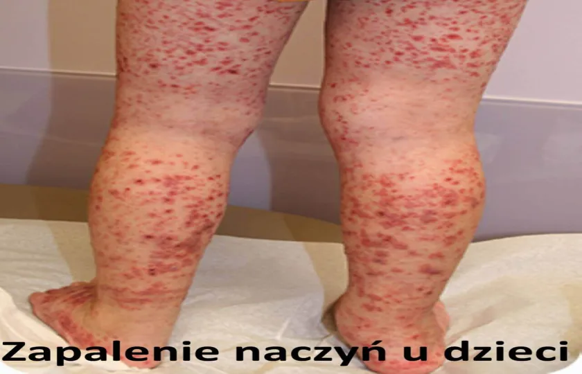 Zapalenie naczyń u dzieci