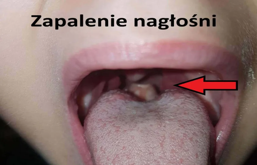 Zapalenie nagłośni 