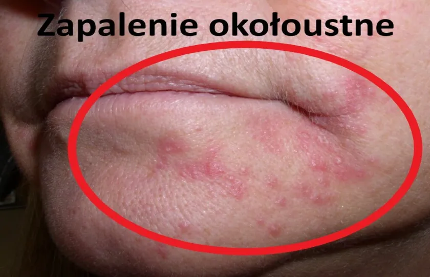 Zapalenie okołoustne