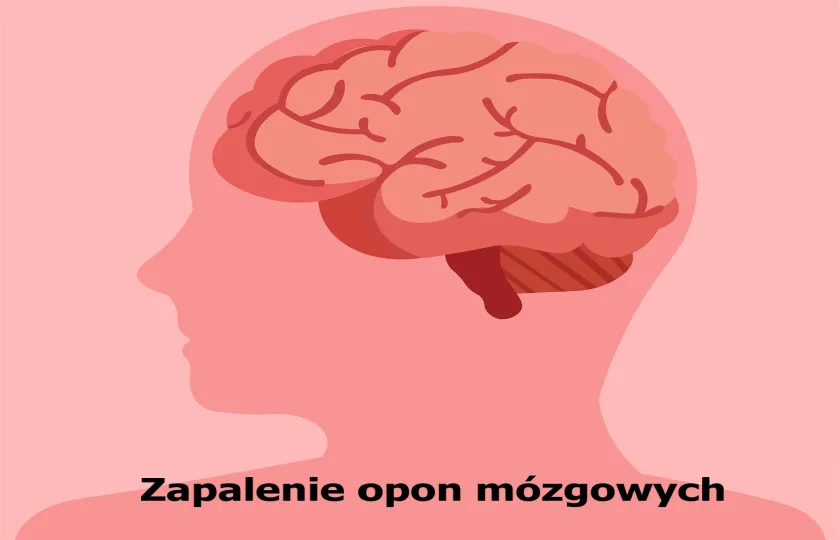 Zapalenie opon mózgowych