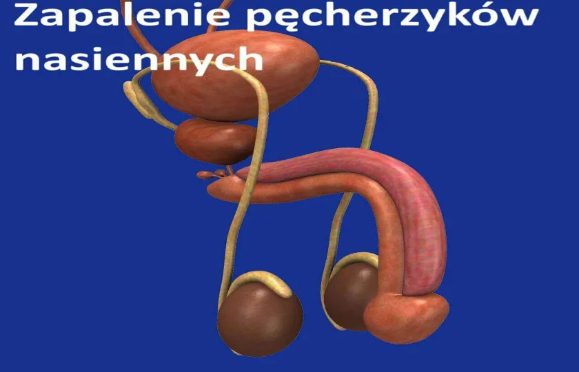 Zapalenie pęcherzyków nasiennych